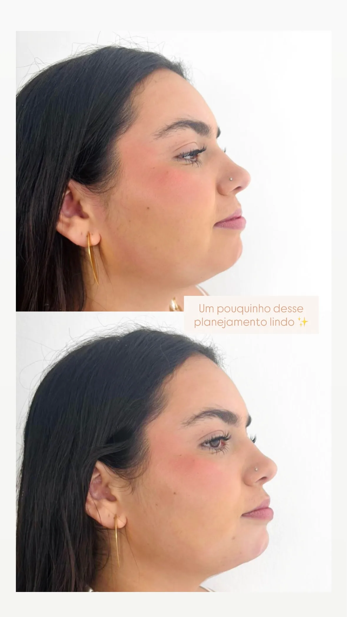 Antes e depois de planejamento de contorno facial.