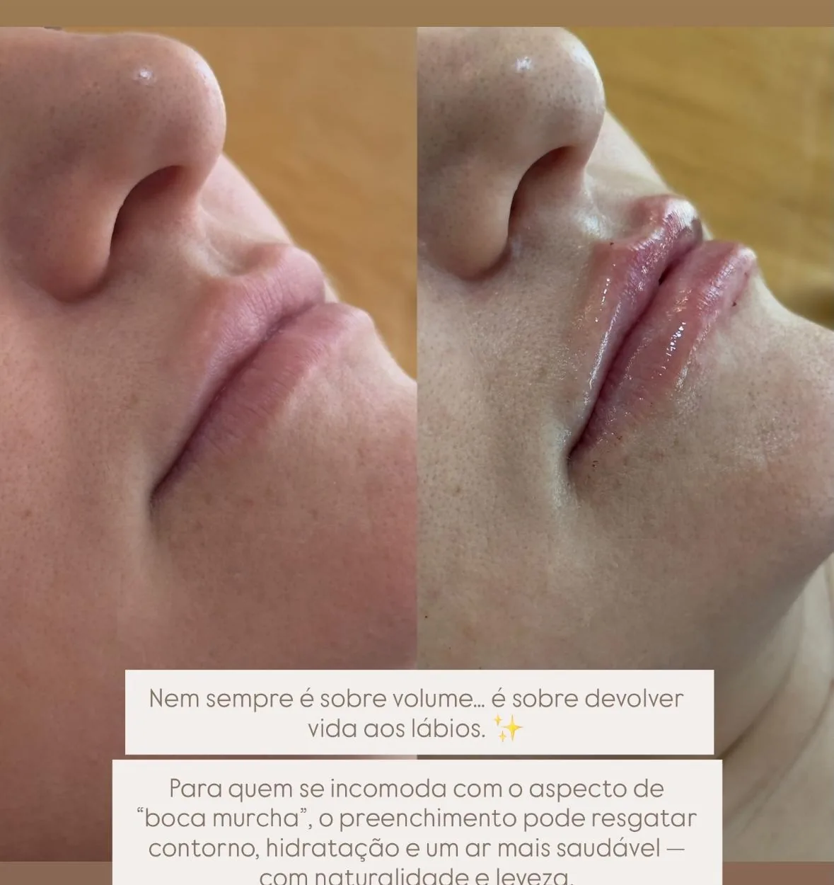 Antes e depois de preenchimento labial.