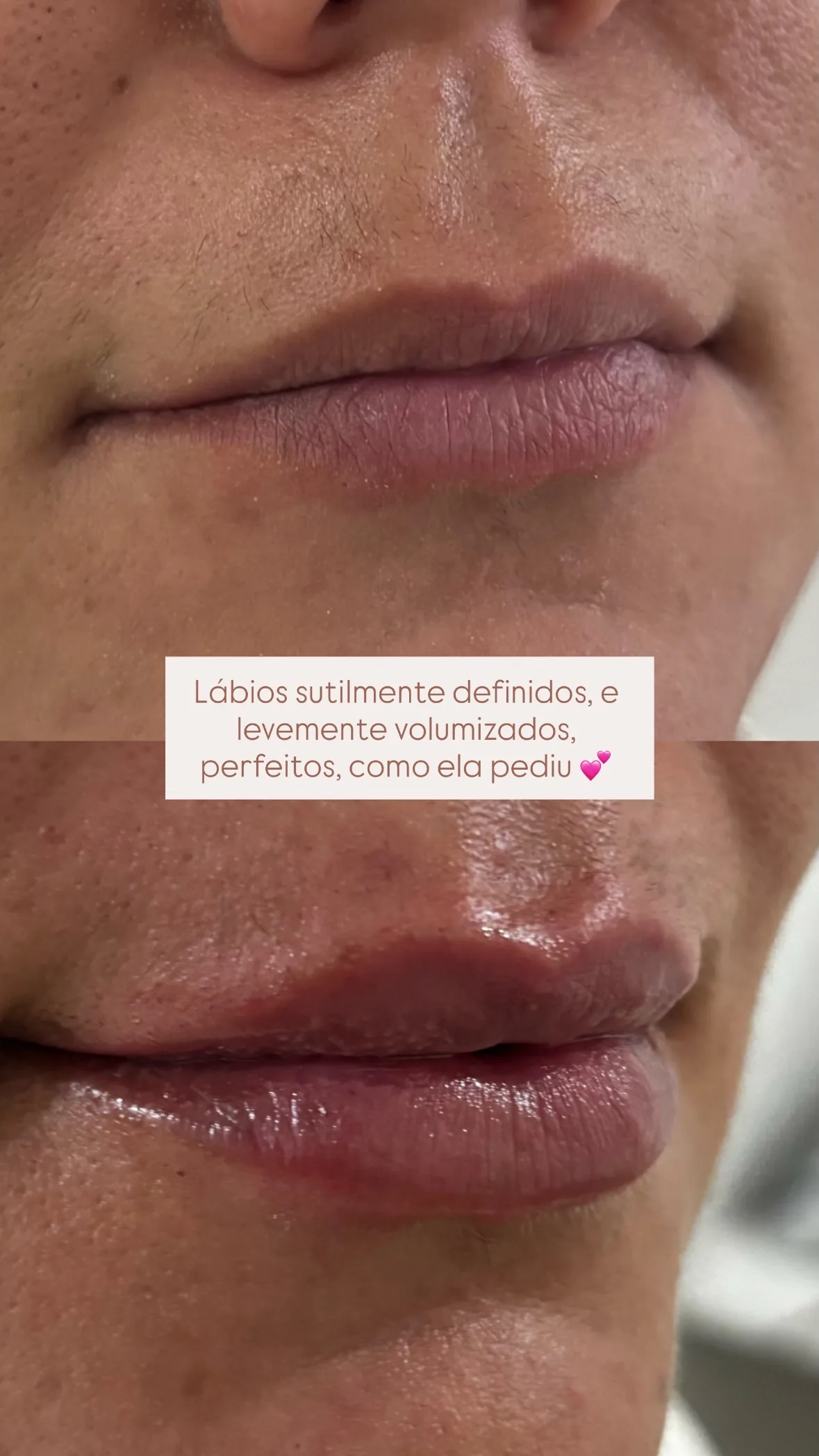 Antes e depois de preenchimento labial, lábios sutilmente definidos.