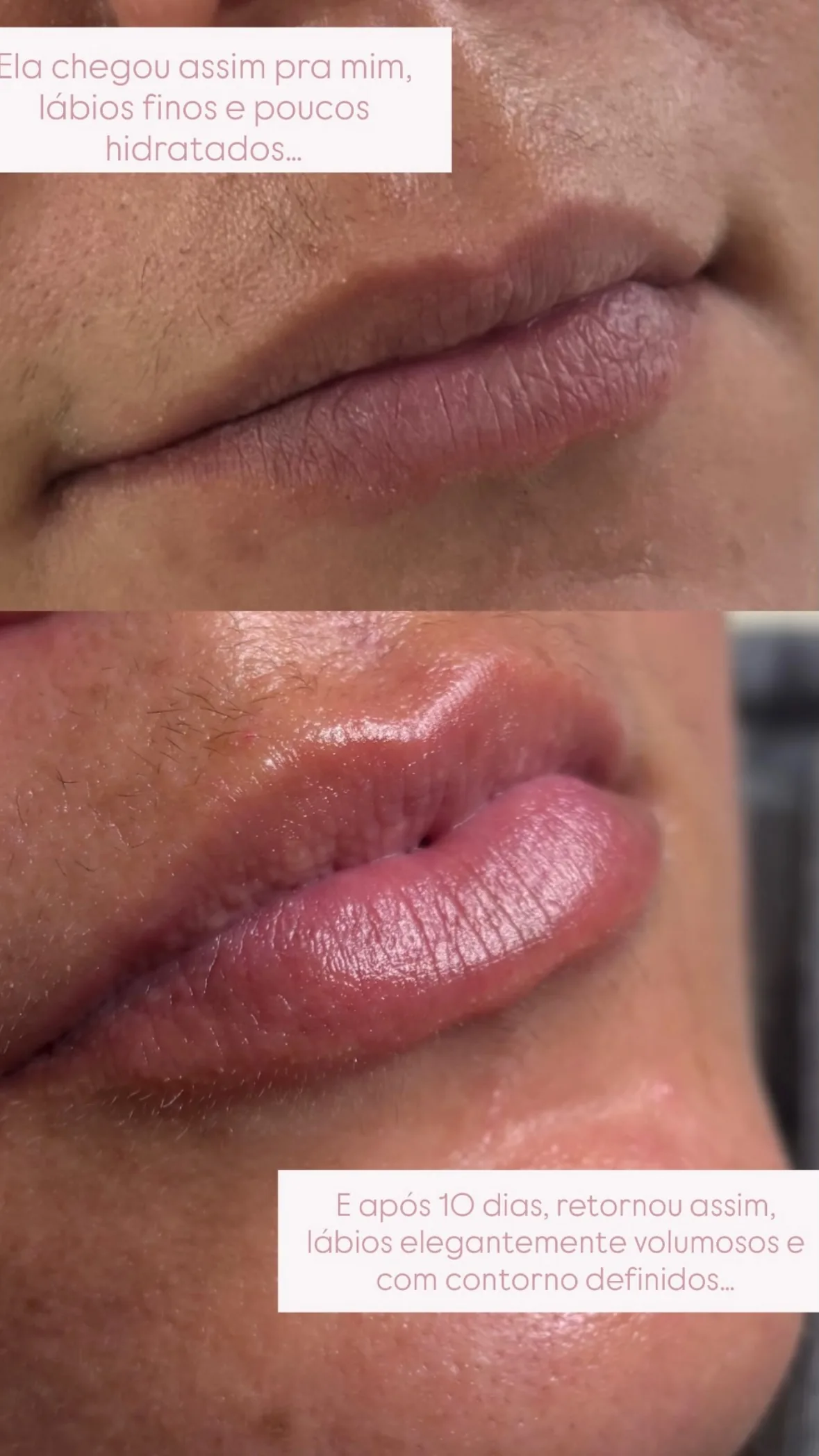 Antes e depois de preenchimento labial, 10 dias após o procedimento.