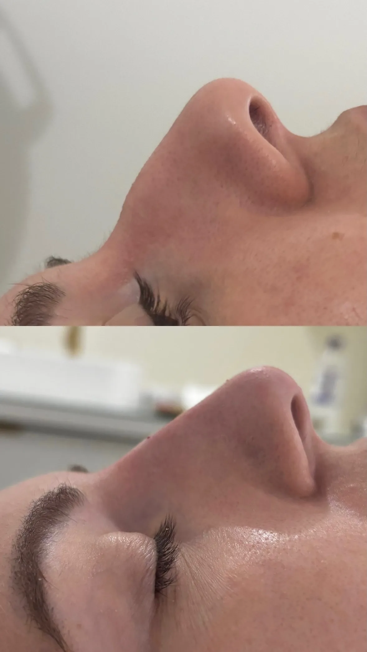 Antes e depois de rinomodelação.